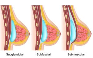 breast augmentation colombia