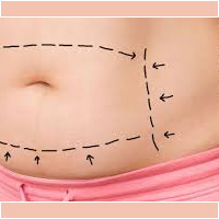 abdominoplasty colombia