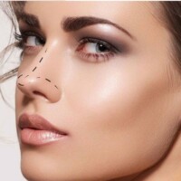 rhinoplasty